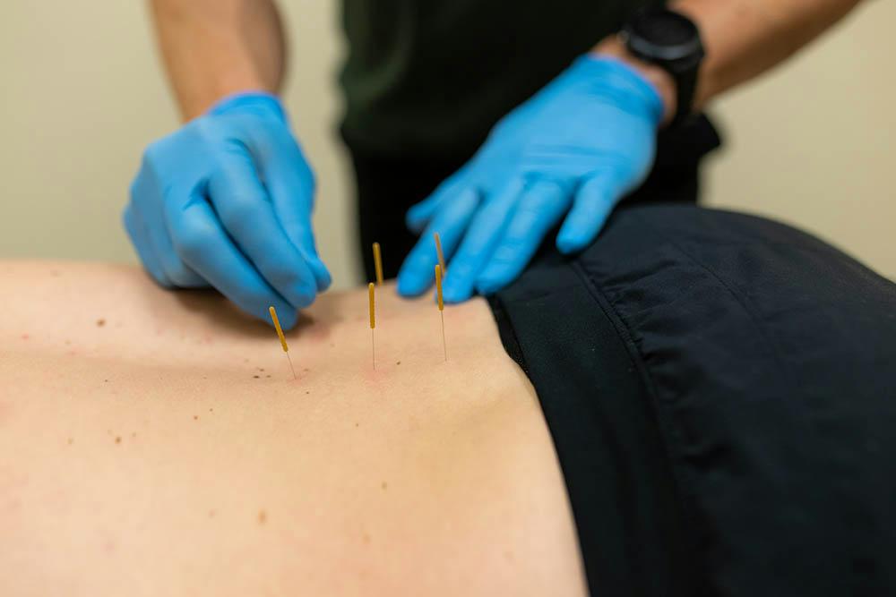 Dry Needling Complications: Is it Safe During Pregnancy?