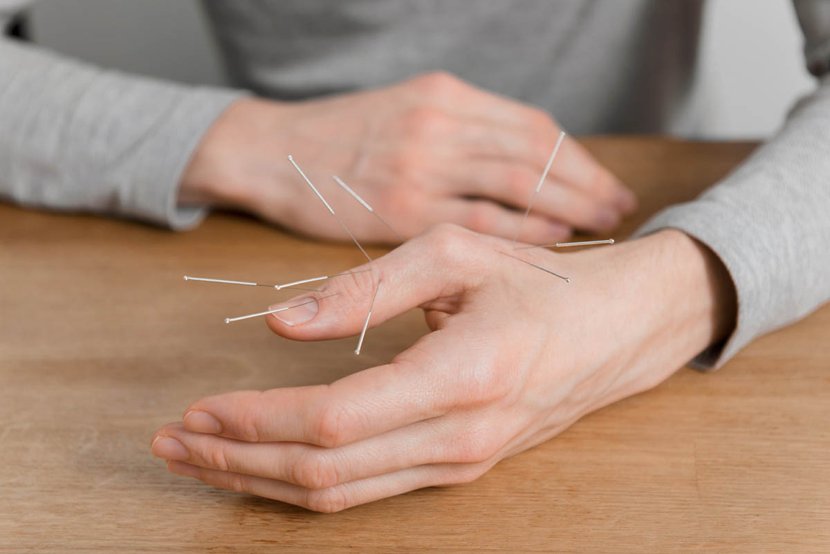 Learn More About Dry Needling at Continuous Motion Physical Therapy