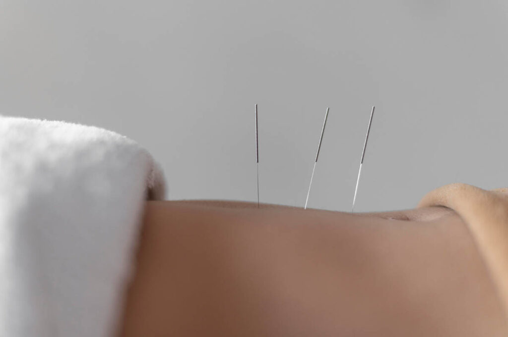 Dry Needling for Muscle Spasm: What Is It and How It Works?