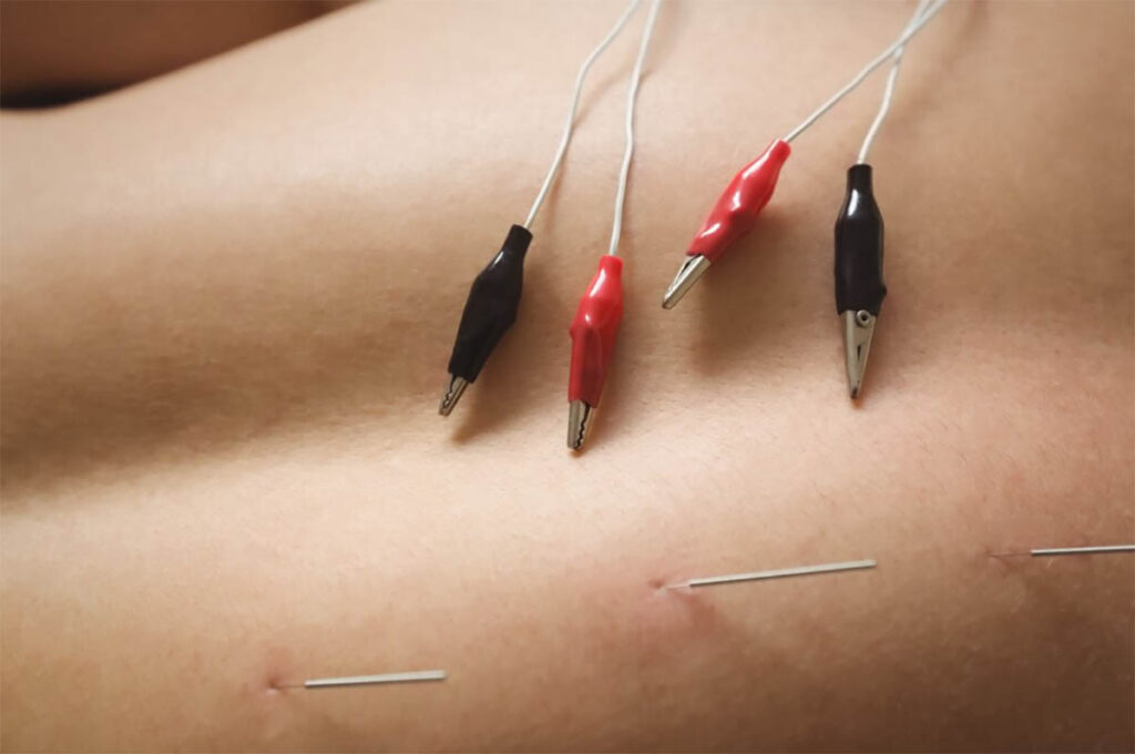 Dry Needling for Tendonitis